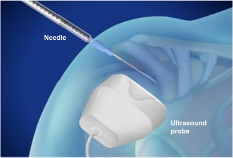 Ultrasound-guided knee injection